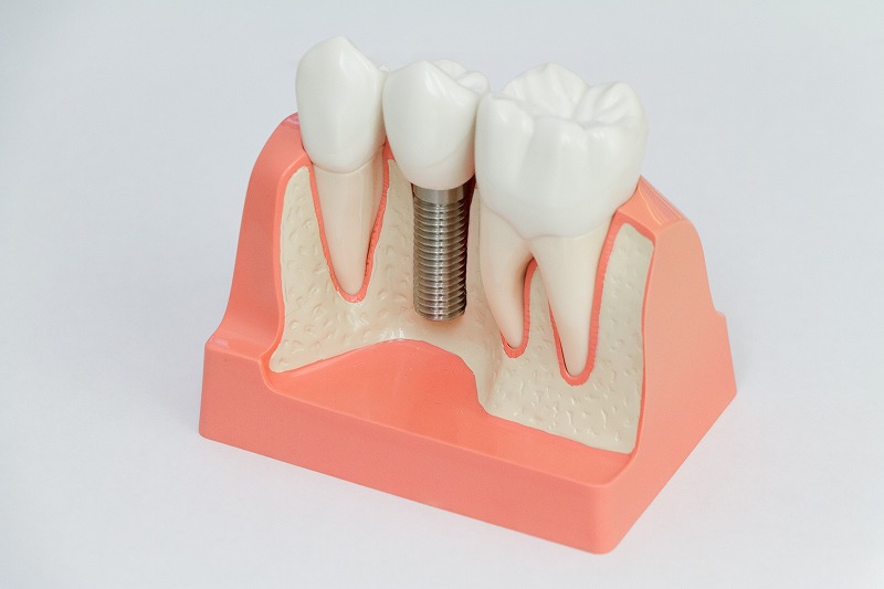 インプラント治療について