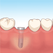インプラント埋入手術（1次オペ）