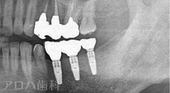 治療終了後5年時