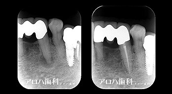 透過像が消失したケース