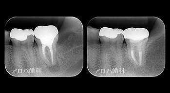 再根管治療