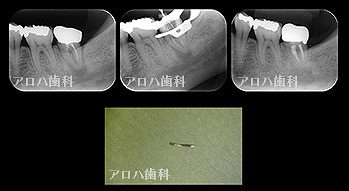 再根管治療 2年予後