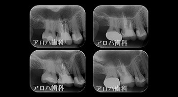 頬側よりGP挿入。MB根尖の透過像と一致。P根にも透過像。穿孔を疑う