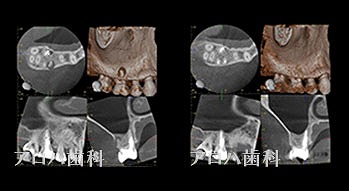 頬側よりGP挿入。MB根尖の透過像と一致。P根にも透過像。穿孔を疑う