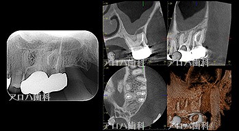 MB根 湾曲の先に破折器具