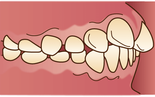 上顎前突