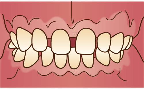 空隙歯列