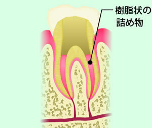 根管充填