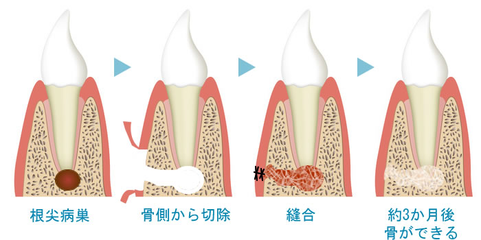 歯根端切除術